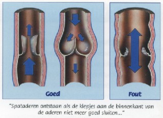 veneuze kleppen